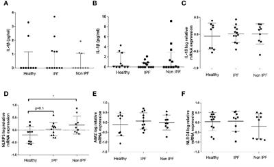 Enhanced IL-1β Release Following NLRP3 and AIM2 Inflammasome Stimulation Is Linked to mtROS in Airway Macrophages in Pulmonary Fibrosis